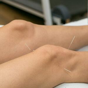 Acupuncture